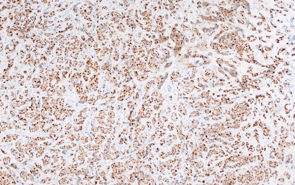 86B2 Metastasis, breast (Case 86) PR 1