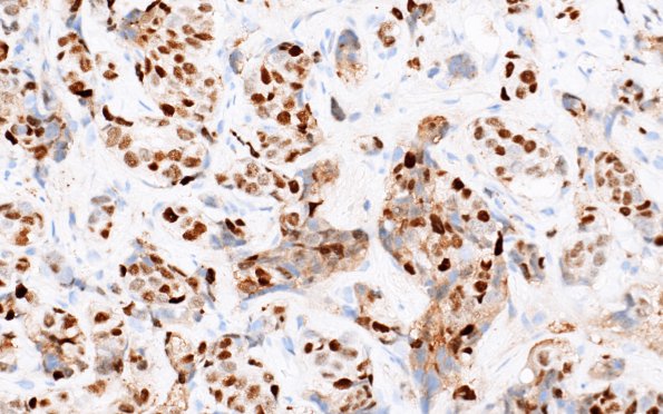 86C3 Metastasis, breast (Case 86) PR 2