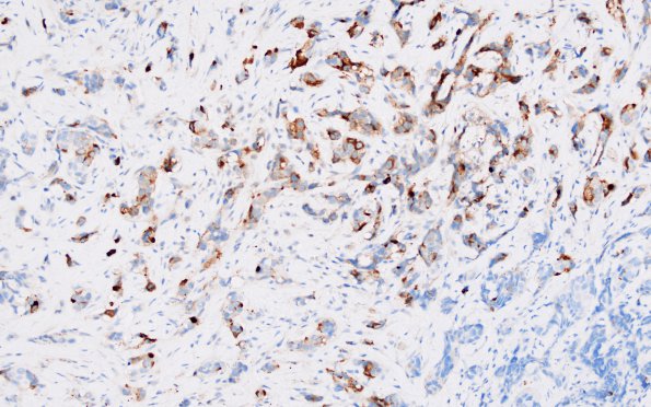 86C4 Metastasis, breast (Case 86) Mammaglobin