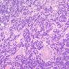 87A2 Metastasis, breast (Case 87) H&E 3