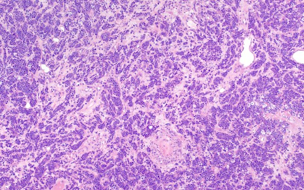 87A2 Metastasis, breast (Case 87) H&E 3