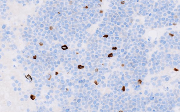 87B Metastasis, breast (Case 87) Mammaglobulin 2