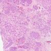 88A1 Metastasis, breast (Case 88) H&E 2