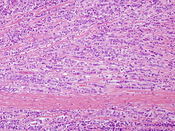 89A1 Metastasis, breast (Case 89) H&E 1