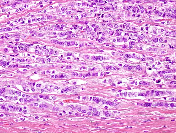 89A2 Metastasis, breast (Case 89) H&E 2