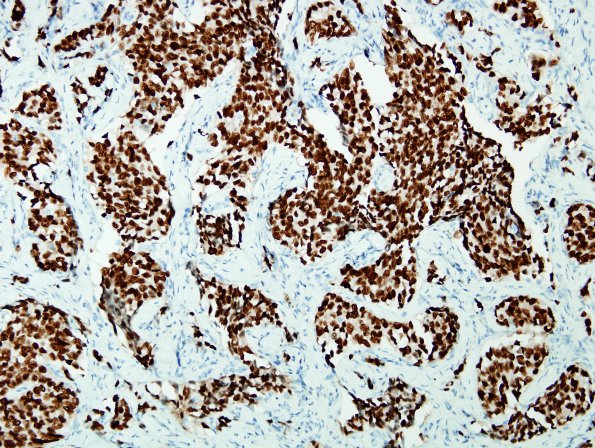 89B1 Metastasis, breast (Case 89) ER