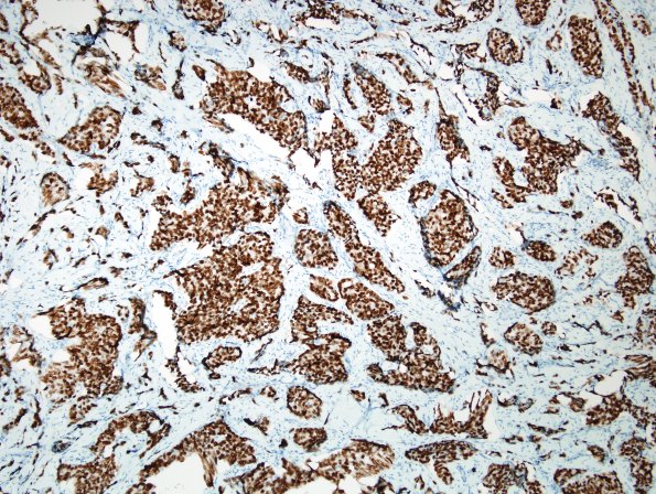 89B2 Metastasis, breast (Case 89) PR