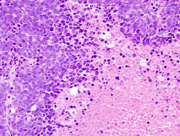 8A Metastasis, prostate (Case 8) H&E 4