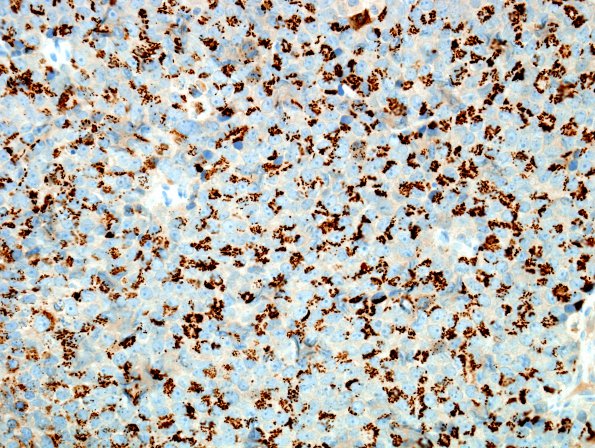 8B1 Metastasis, prostate (Case 8) Prostein