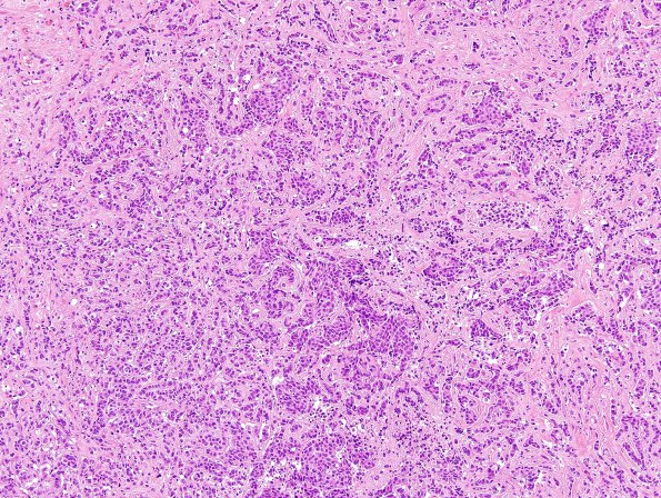 90A1 Metastasis, breast (Case 90) H&E 4