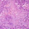 91A Metastasis, breast (Case 91) HER-2 5.jpg