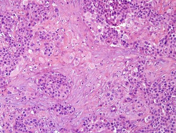 91A Metastasis, breast (Case 91) HER-2 5.jpg