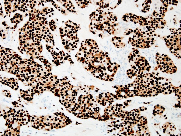 91B1 Metastasis, breast (Case 91) ER 1.jpg