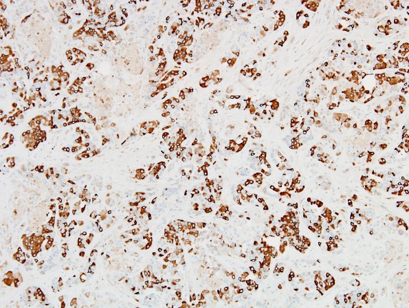 91B2 Metastasis, breast (Case 91) Mammaglobin 1.jpg