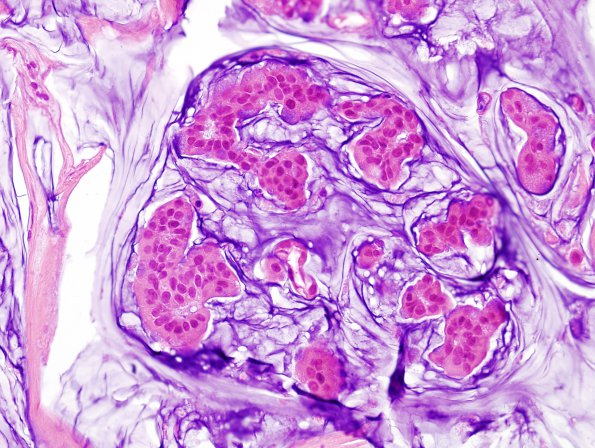 92A Metastasis, mucinous breast CA (Case 92) H&E 5