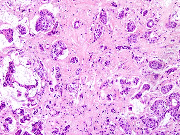 93A1 Metastasis, breast & RadioRx pituitary (Case 93) H&E 1.jpg