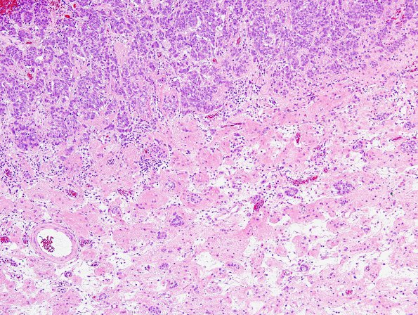 93A2 Metastasis, breast & RadioRx (Case 93) H&E 5.jpg