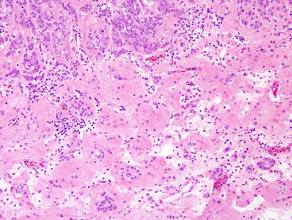 93A3 Metastasis, breast & RadioRx (Case 93) H&E 4.jpg