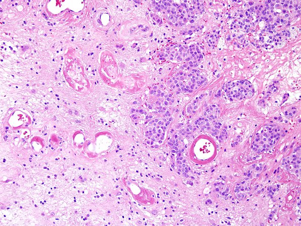 93A4 Metastasis, breast & RadioRx (Case 93) H&E 3.jpg