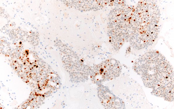 93B3 Metastasis, breast & RadioRx (Case 93) PR 20X