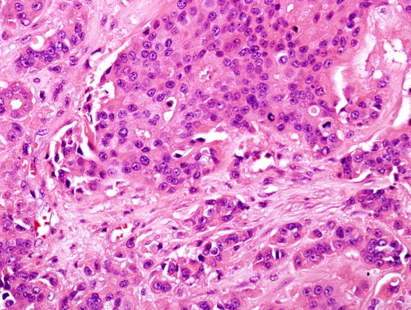 94A Metastases, Breast (Case 94) H&E 1