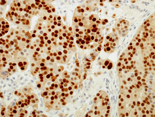 94B1 Metastases, Breast (Case 94) ER 1