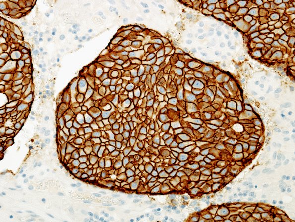 94B2 Metastases, Breast (Case 94) Her-2 1