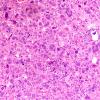 95A1 Metastasis large cell lung CA (Case 95) H&E 40X 4