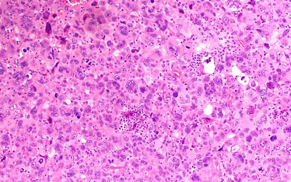 95A1 Metastasis large cell lung CA (Case 95) H&E 40X 4