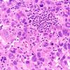 95A2 Metastasis large cell lung CA (Case 95) H&E 40X 5