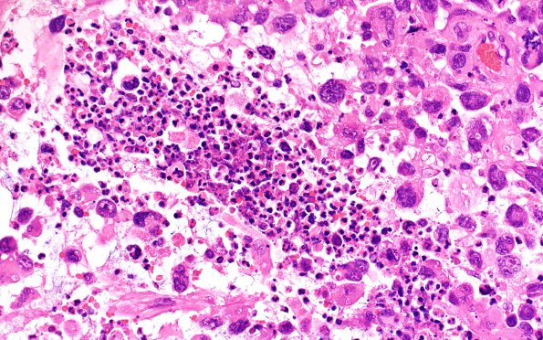 95A3 Metastasis large cell lung CA (Case 95) H&E 40X 2