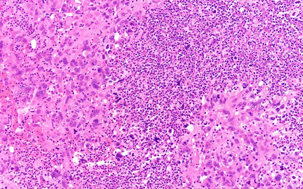 95A4 Metastasis large cell lung CA (Case 95) H&E