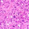 95A5 Metastasis large cell lung CA (Case 95) H&E 40X 3
