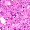 95A6 Metastasis large cell lung CA (Case 95) H&E 60X 2 copy