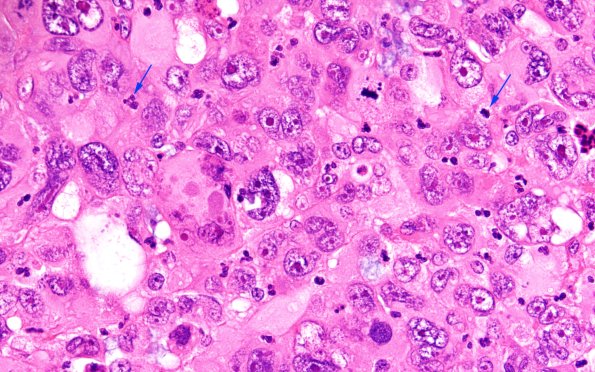 95A6 Metastasis large cell lung CA (Case 95) H&E 60X 2 copy