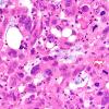 95A7 Metastasis large cell lung CA (Case 95) H&E 40X 1