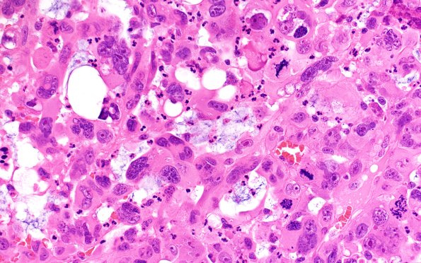 95A7 Metastasis large cell lung CA (Case 95) H&E 40X 1