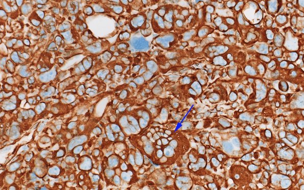 95B1 Metastasis large cell lung CA (Case 95) VIM 40X copy