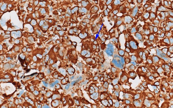 95B2 Metastasis large cell lung CA (Case 95) VIM 60X copy