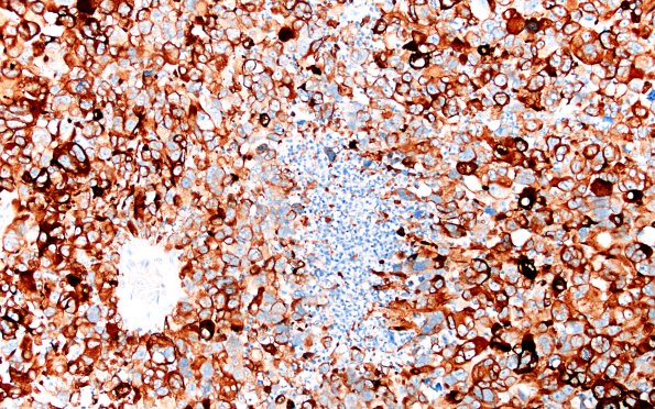 95C1 Metastasis large cell lung CA (Case 95) Cam 5.2 20X 2