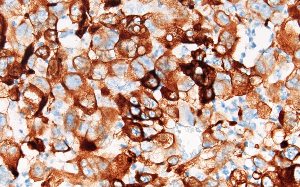 95C2 Metastasis large cell lung CA (Case 95) Cam 5.2 60X