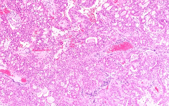 96A1 Metastasis, Lung adeno (Case 96) H&E 10X