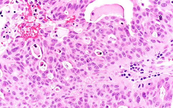 96A2 Metastasis, Lung adeno (Case 96) H&E 40X