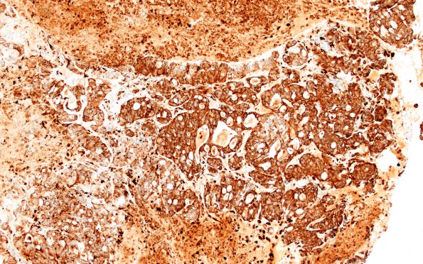 96B1 Metastasis, Lung adeno (Case 96) Napsin A 10X