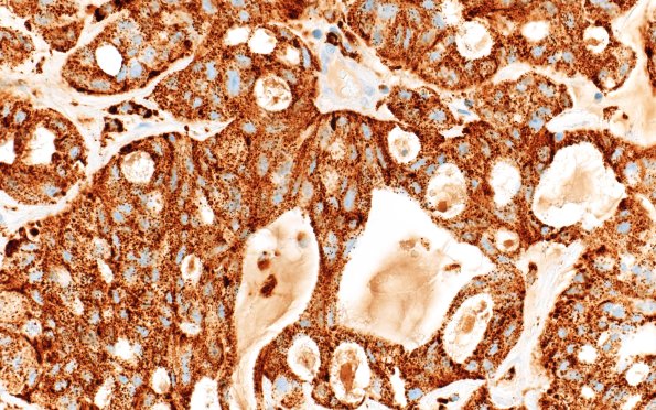 96B2 Metastasis, Lung adeno (Case 96) Napsin A 40X