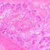 97A1 Metastasis, lung squamous (Case 97) Lung source H&E 10X