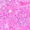 98A4 Metastasis, lung, squamous (Case 98) H&E 40X 1