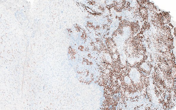 98B1 Metastasis, lung, squamous (Case 98) p40 4X 2