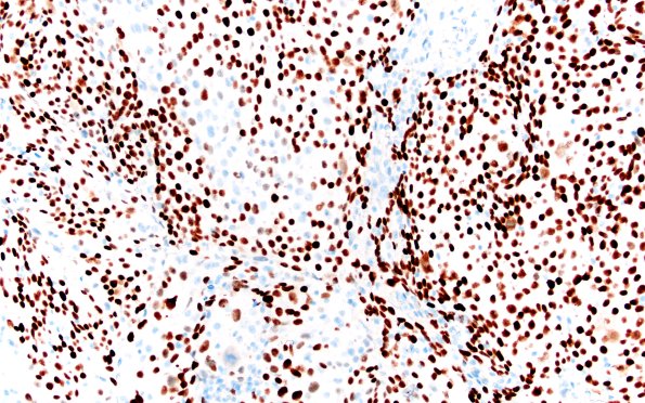 98B2 Metastasis, lung, squamous (Case 98) p40 20X 1