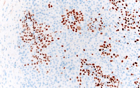 98B3 Metastasis, lung, squamous (Case 98) p40 20X 2